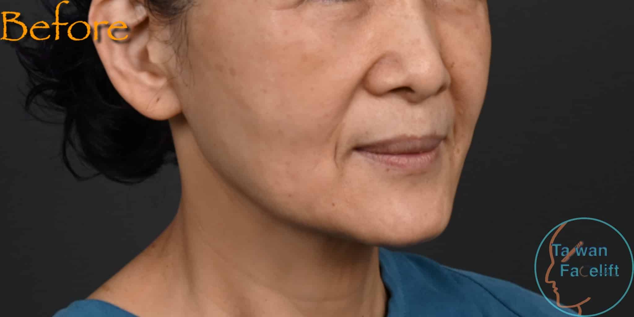 拉皮手術前，鬆弛下垂