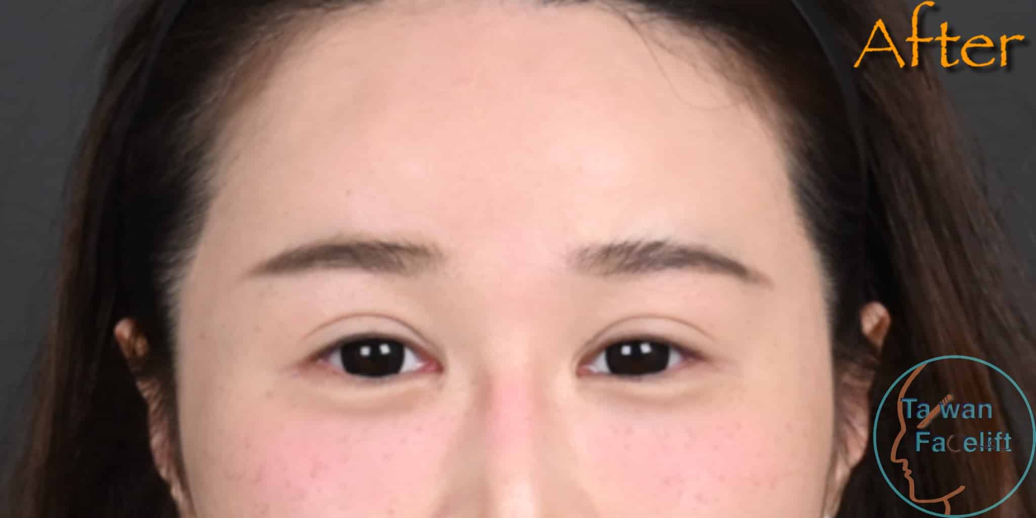After image alt