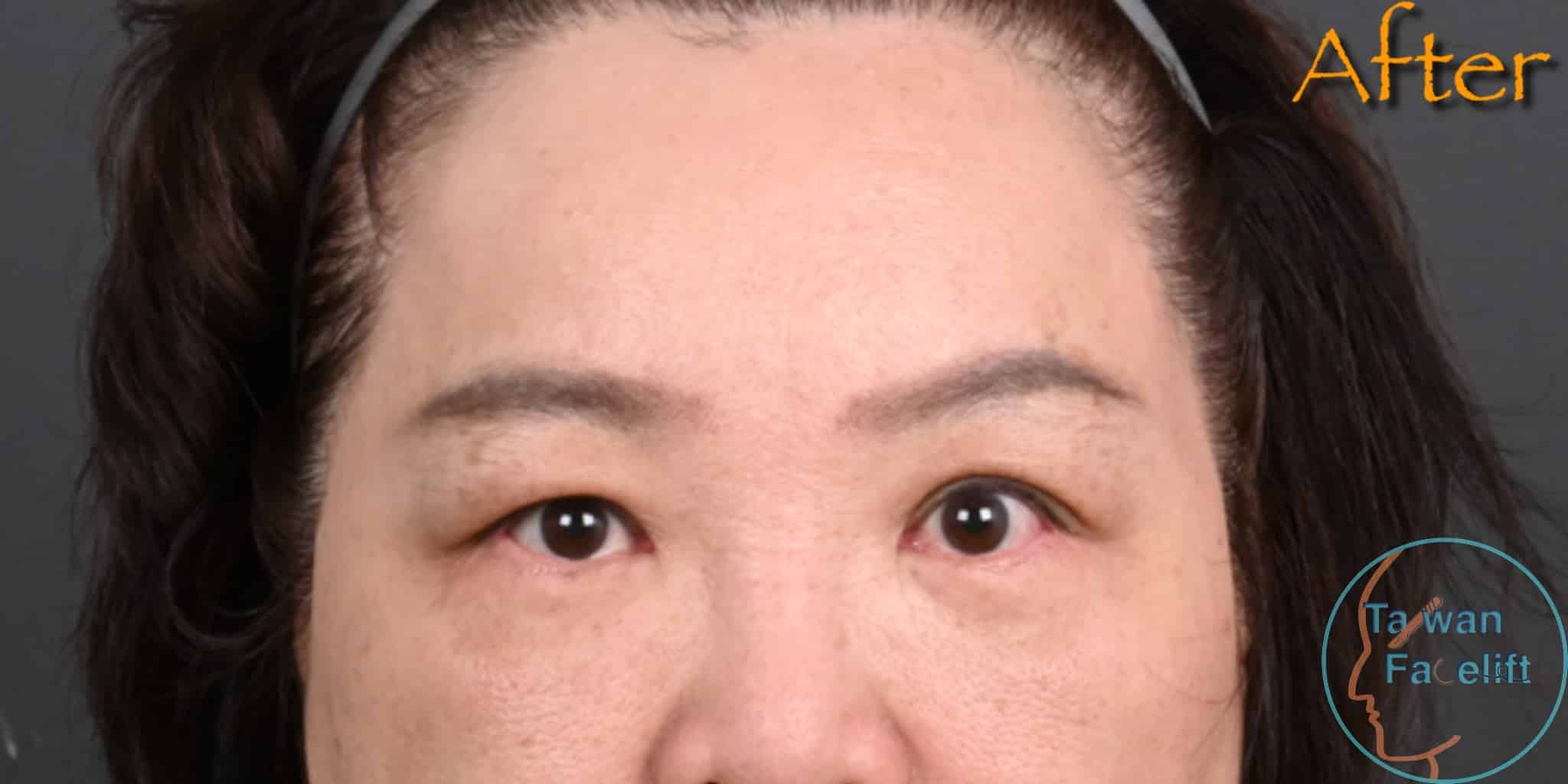 After image alt