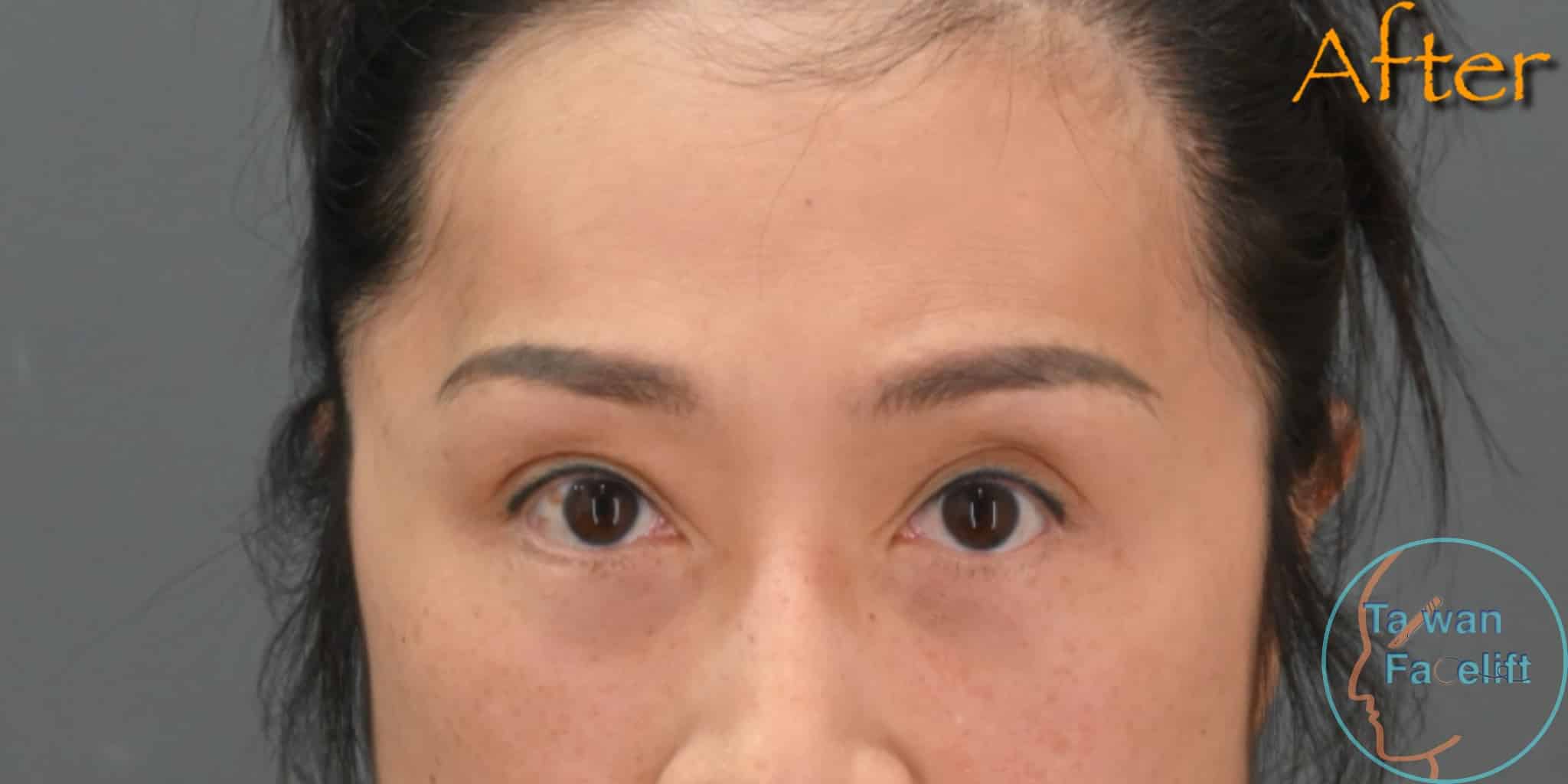 After image alt