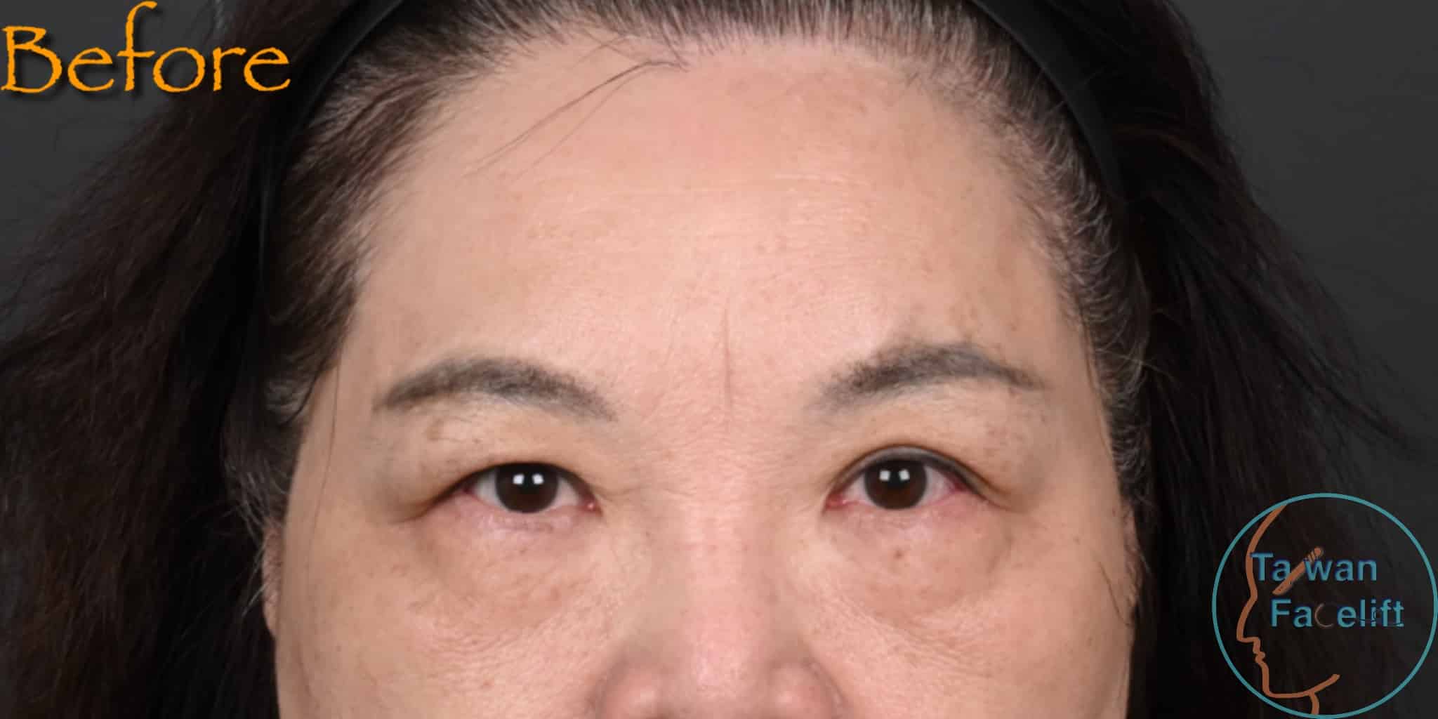 拉皮手術前，鬆弛下垂