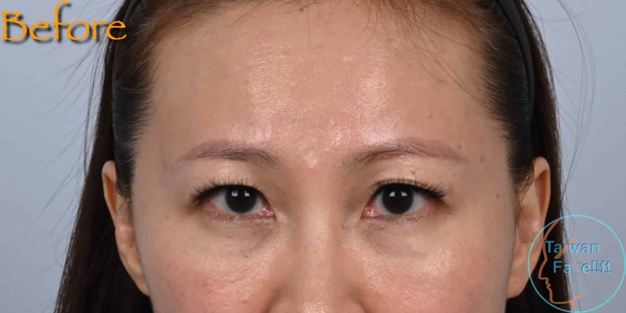 拉皮手術前，鬆弛下垂