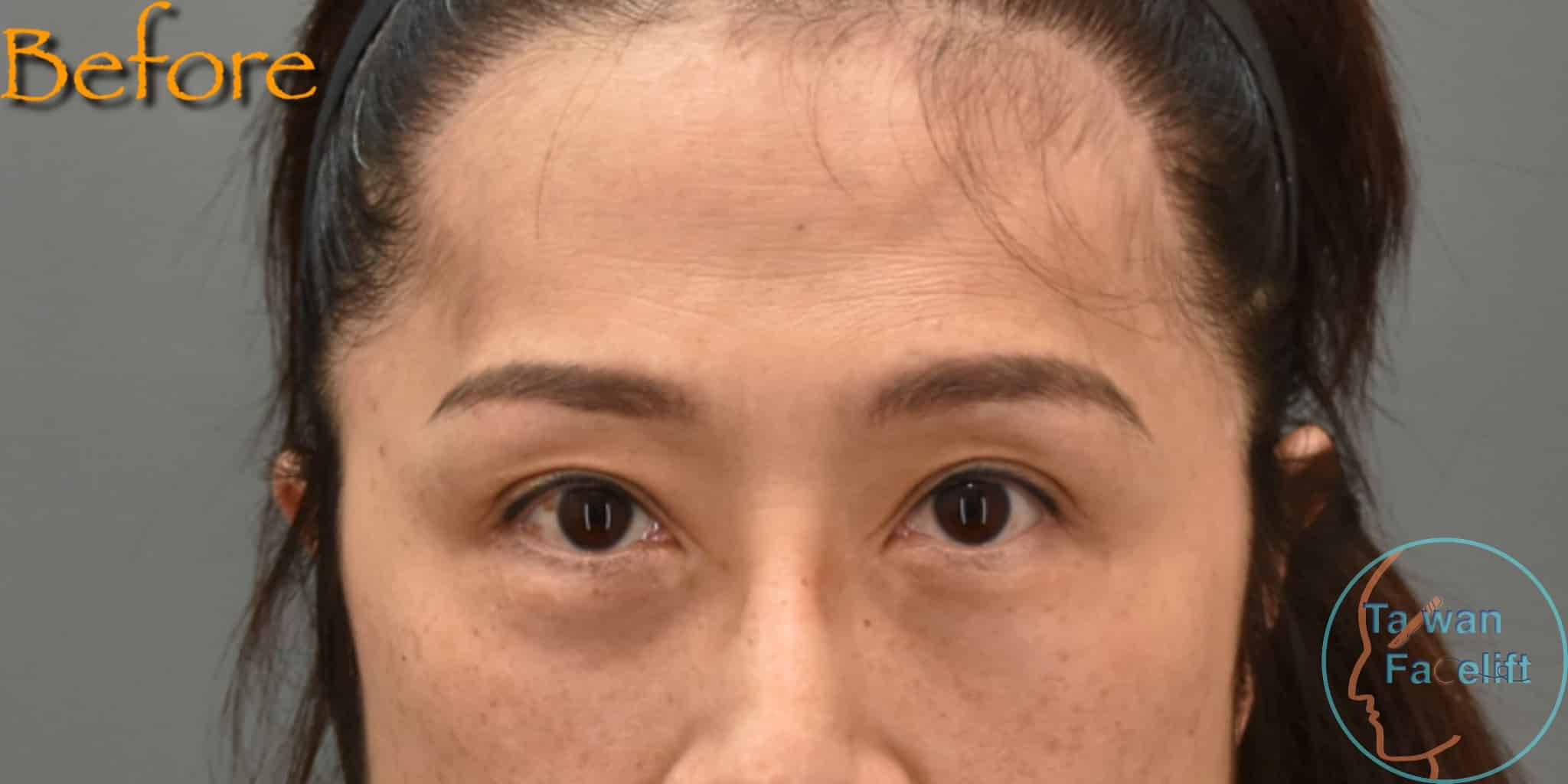 Before image alt