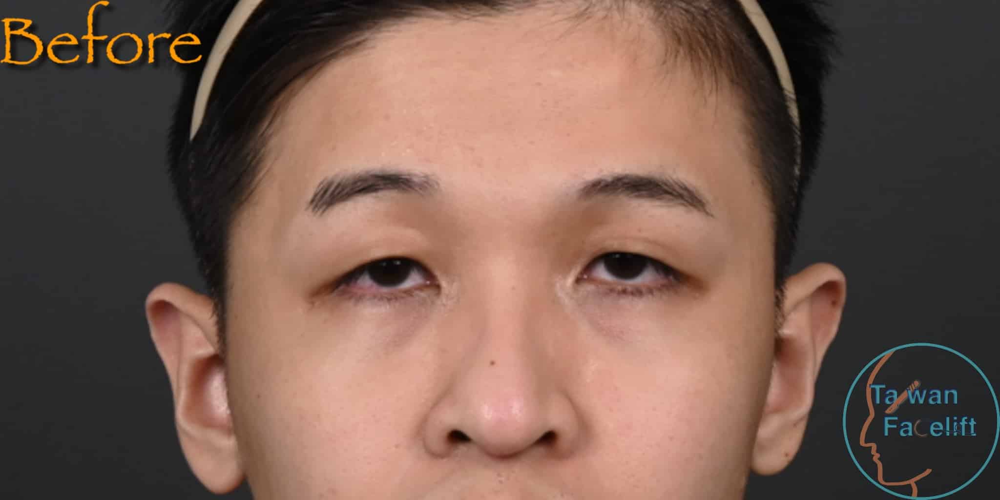 Before image alt