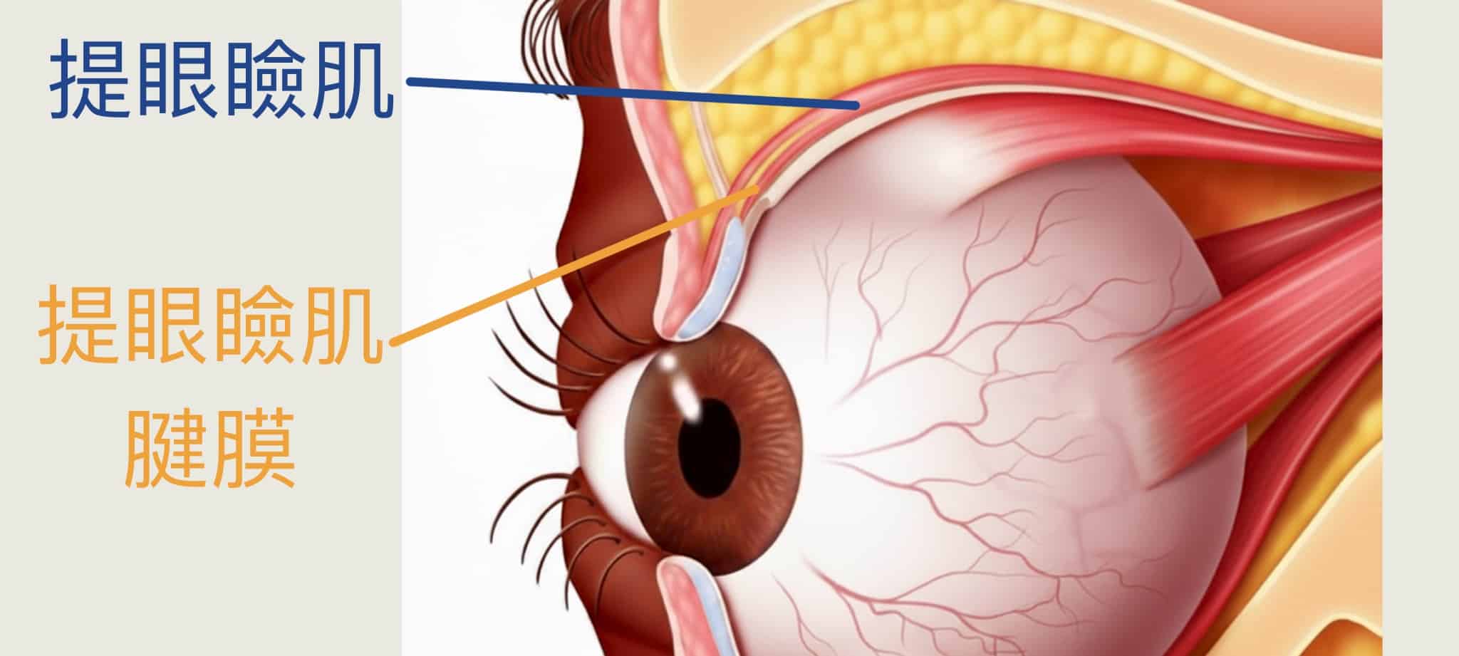 提眼瞼肌構造圖，若提眼瞼肌腱膜鬆弛則會讓眼睛無力張開