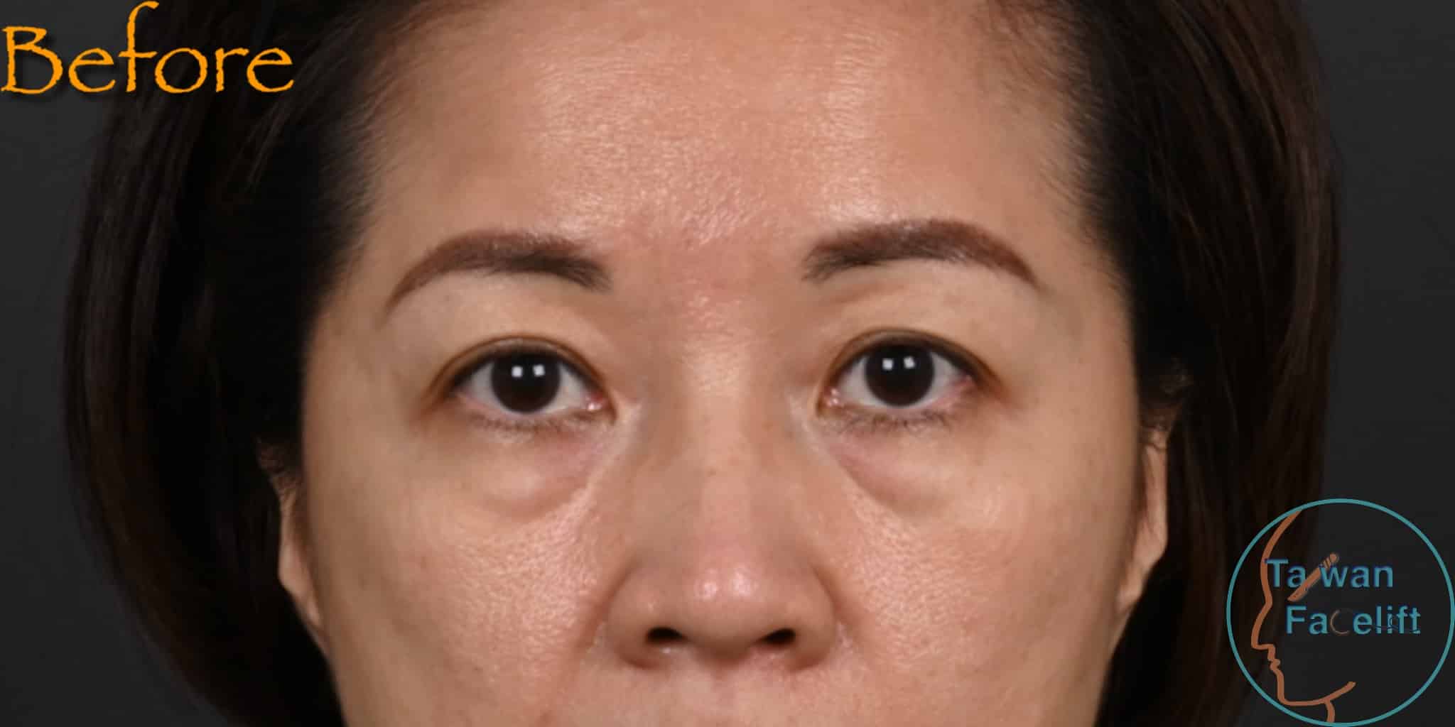 拉皮手術前，鬆弛下垂