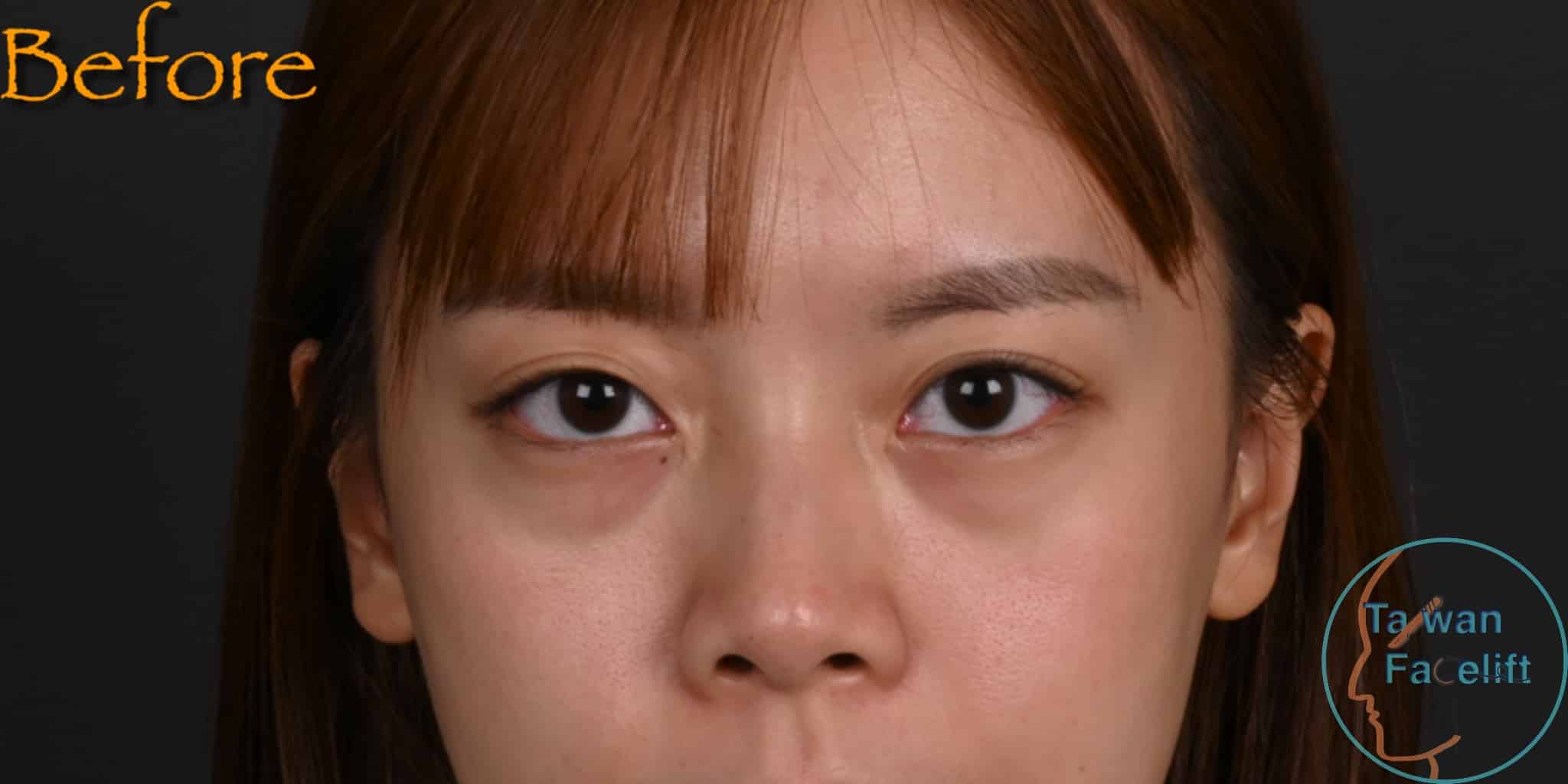 拉皮手術前，鬆弛下垂