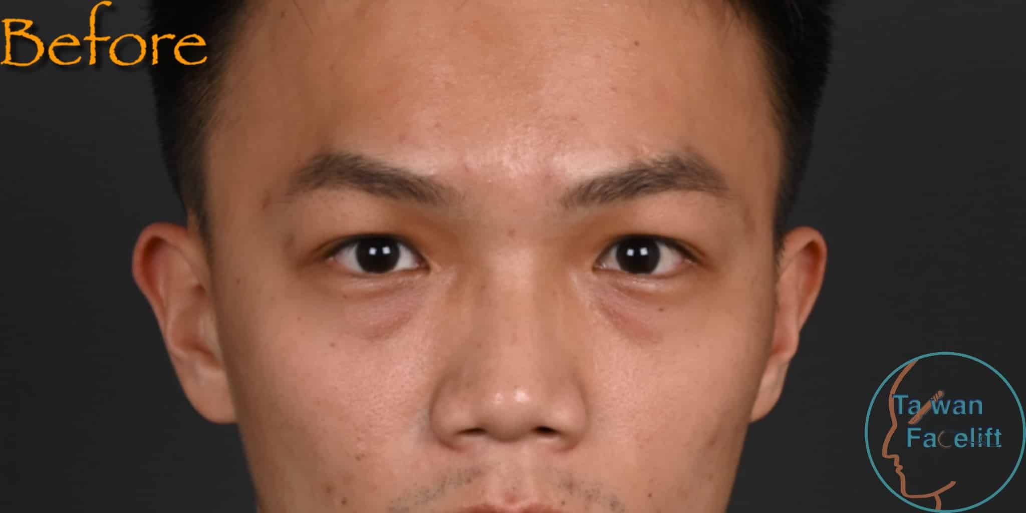 拉皮手術前，鬆弛下垂