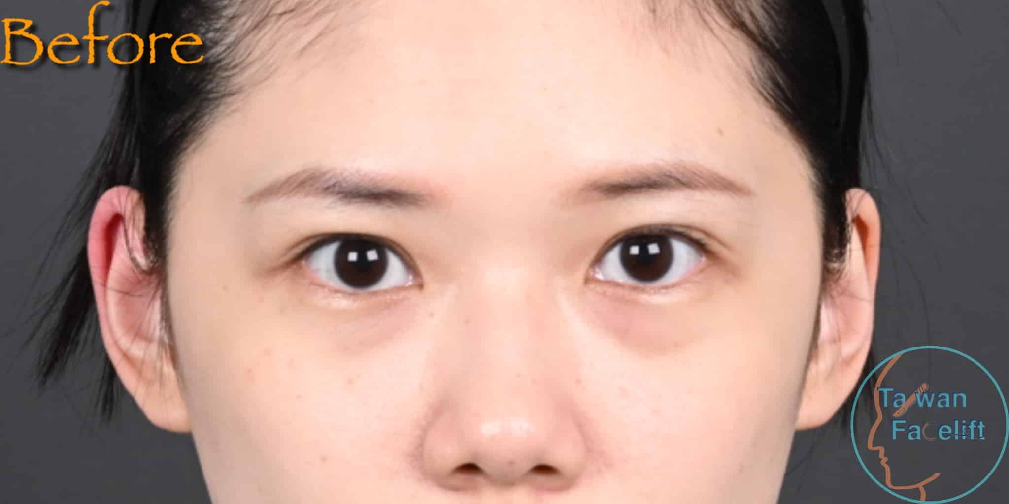 Before image alt