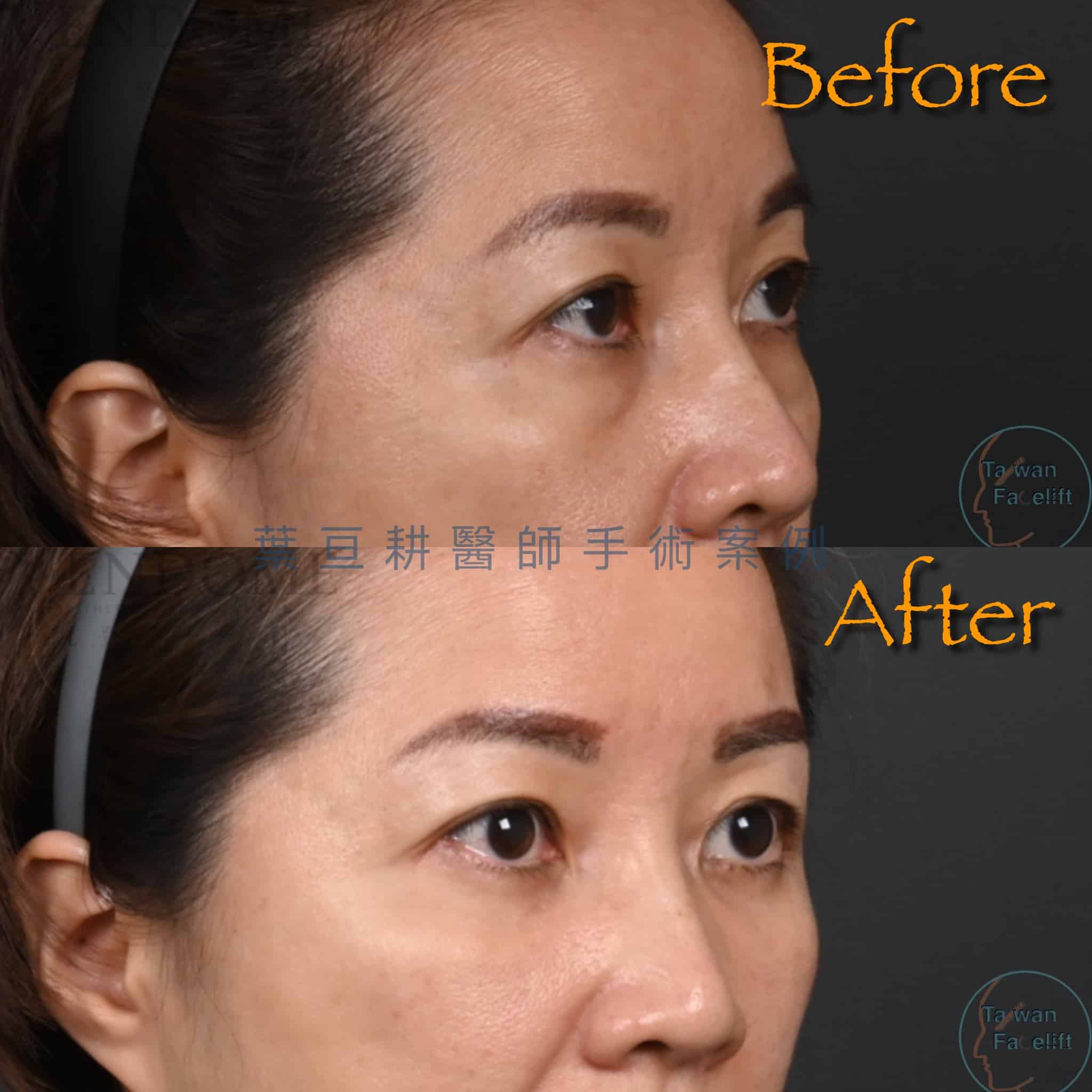 台南凡登整形外科葉亘耕醫師眼袋內開手術後四個月，許女士眼袋消除成果。