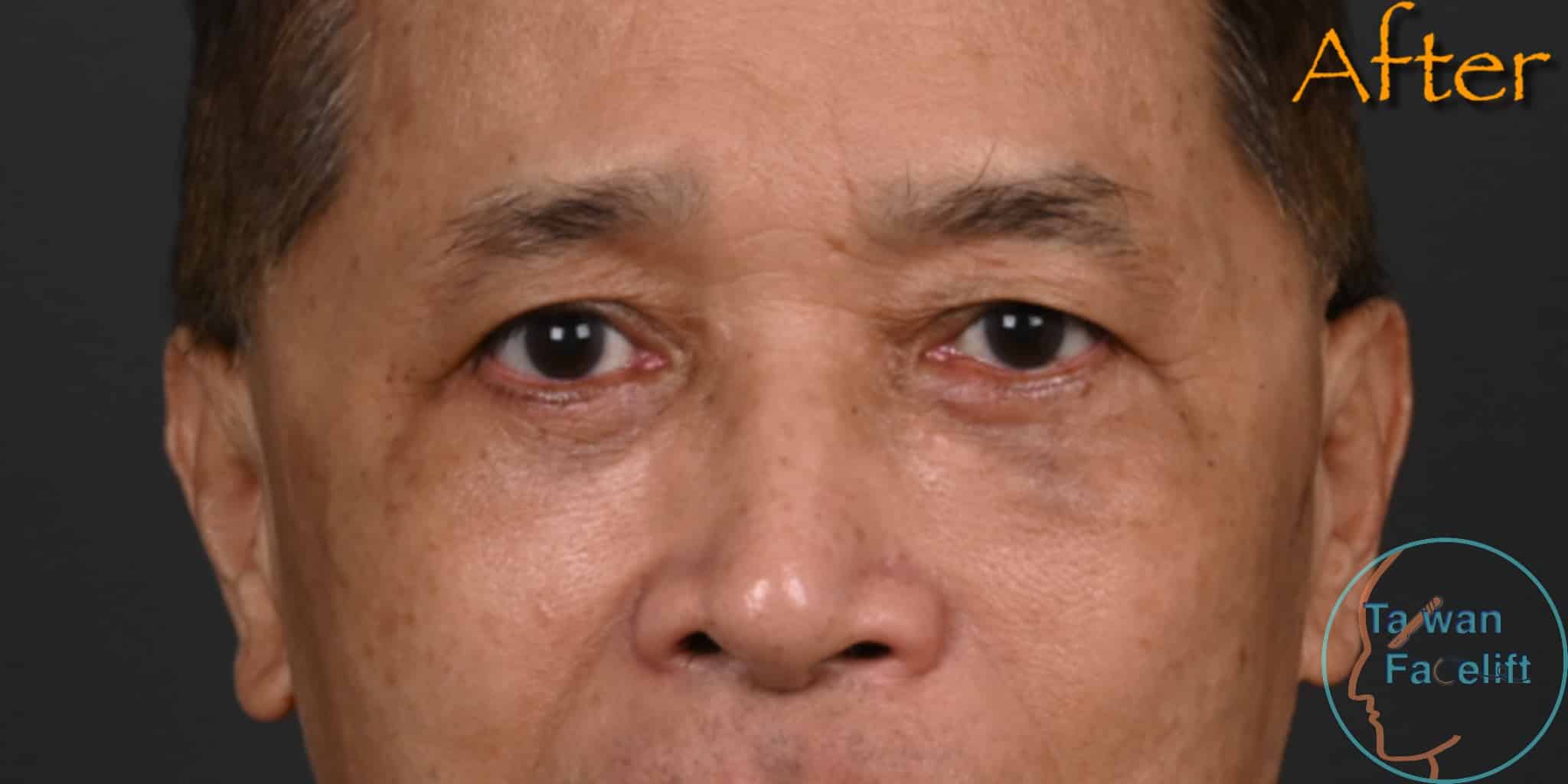 After image alt