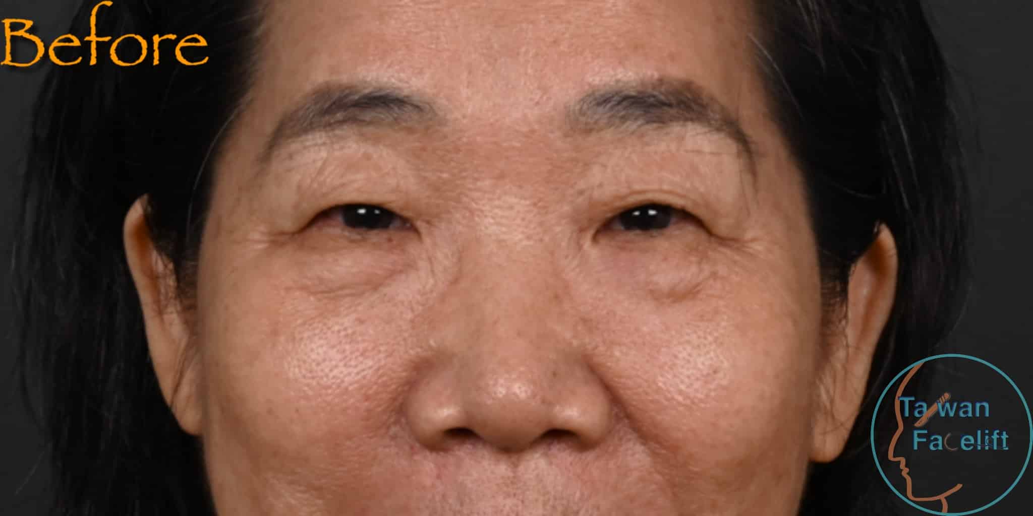 拉皮手術前，鬆弛下垂