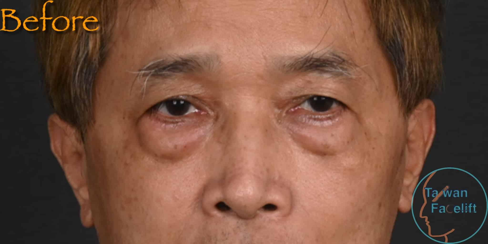 拉皮手術前，鬆弛下垂