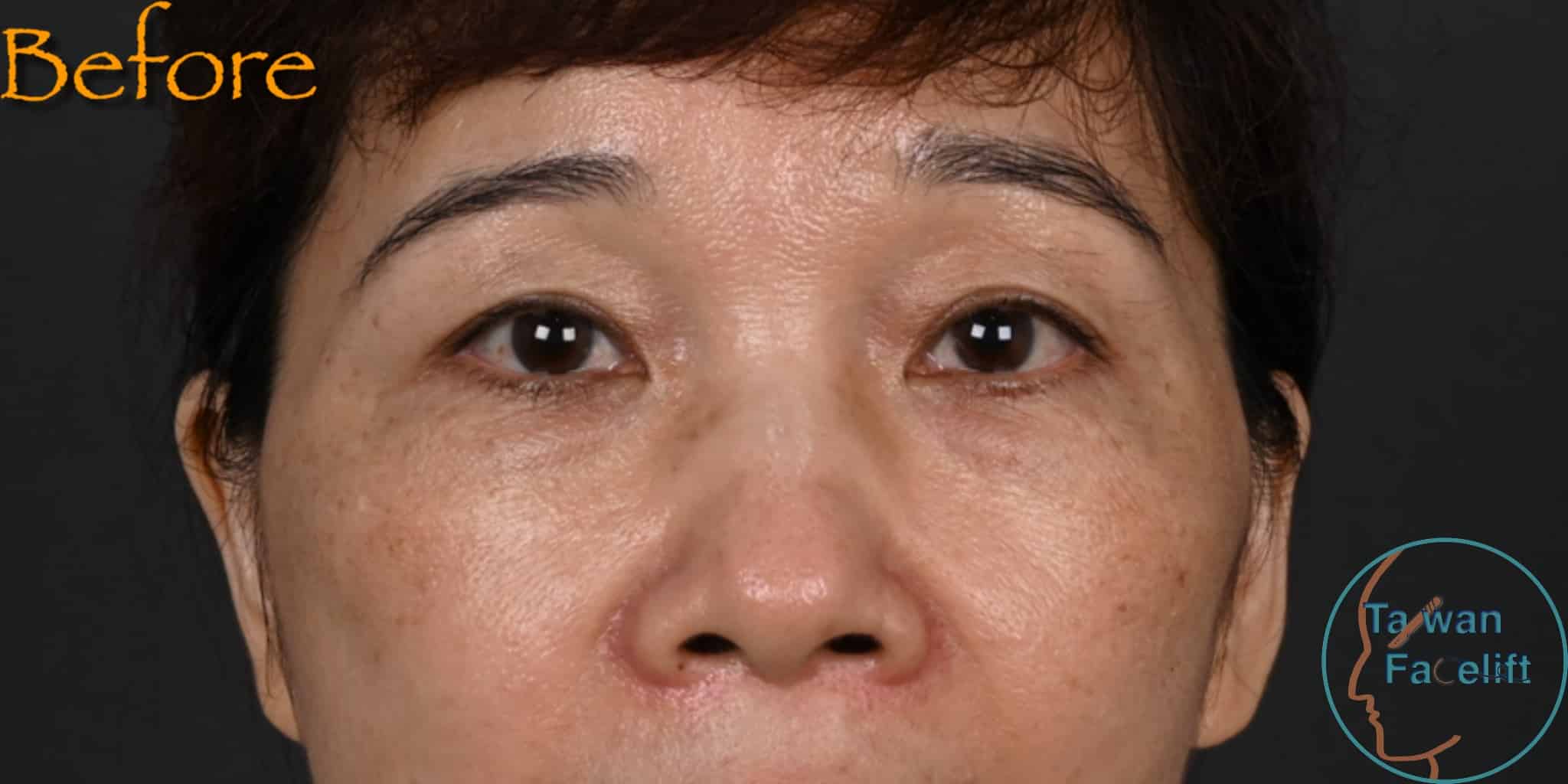拉皮手術前，鬆弛下垂