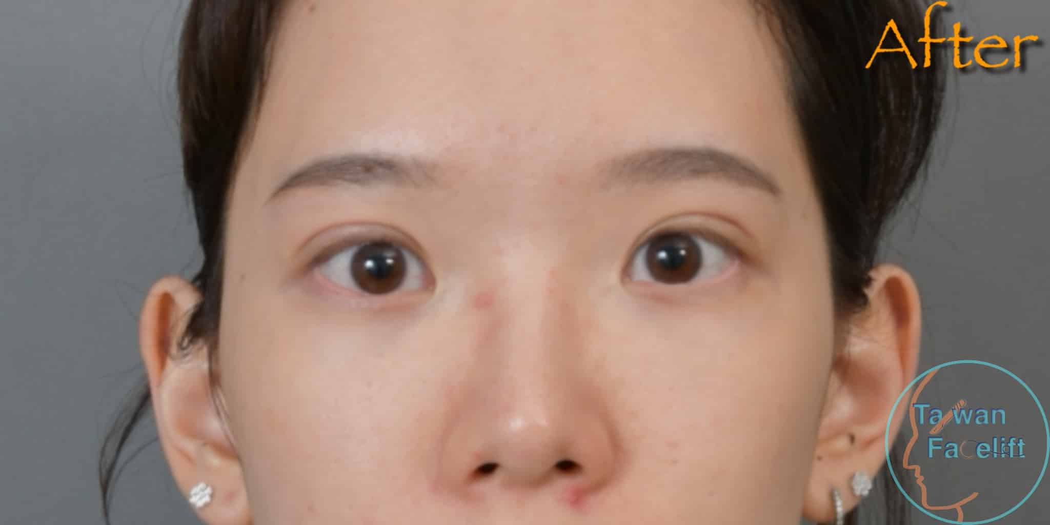 After image alt