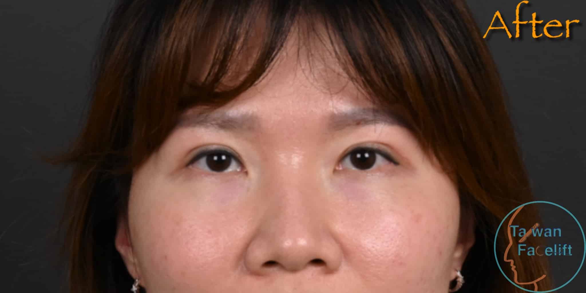 After image alt