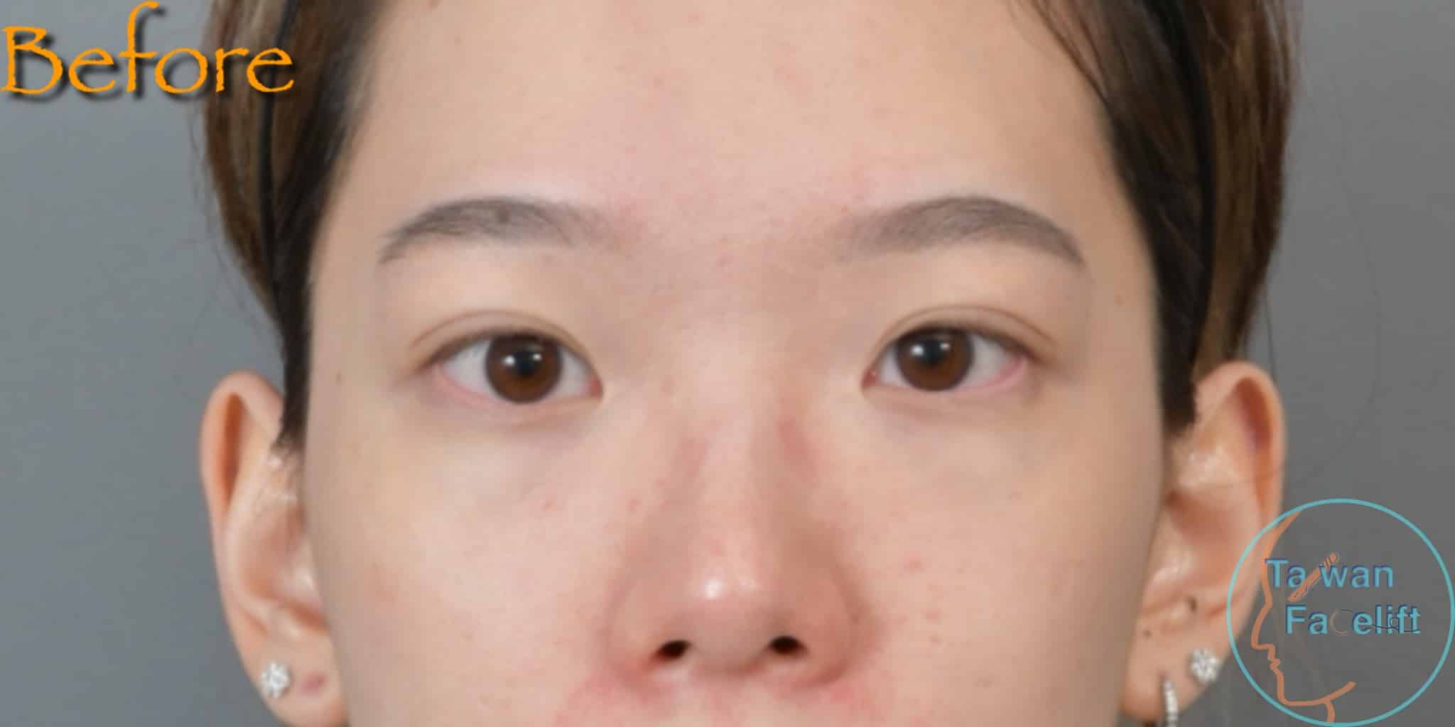 拉皮手術前，鬆弛下垂