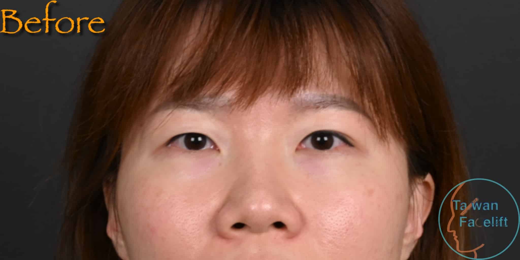 拉皮手術前，鬆弛下垂
