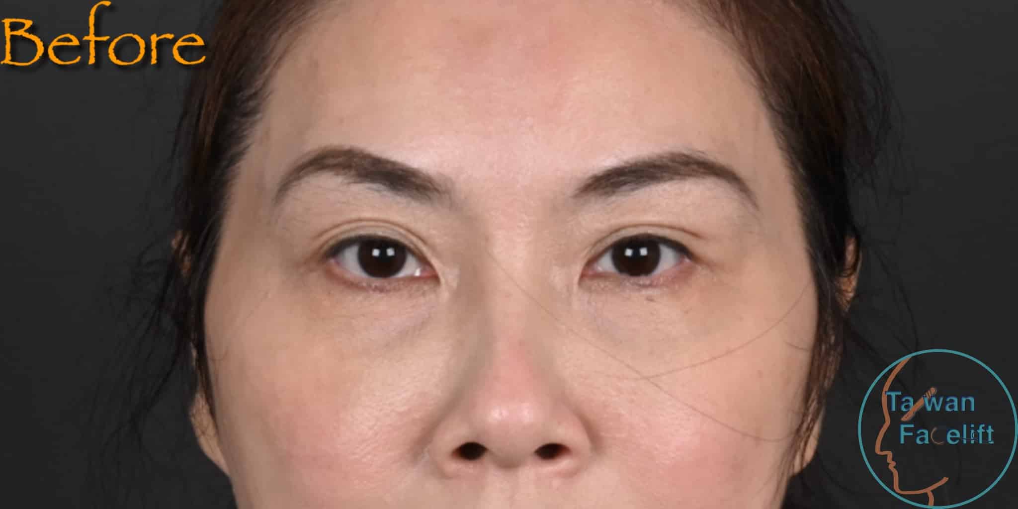 拉皮手術前，鬆弛下垂
