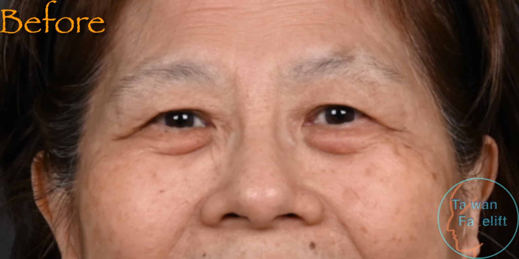 拉皮手術前，鬆弛下垂