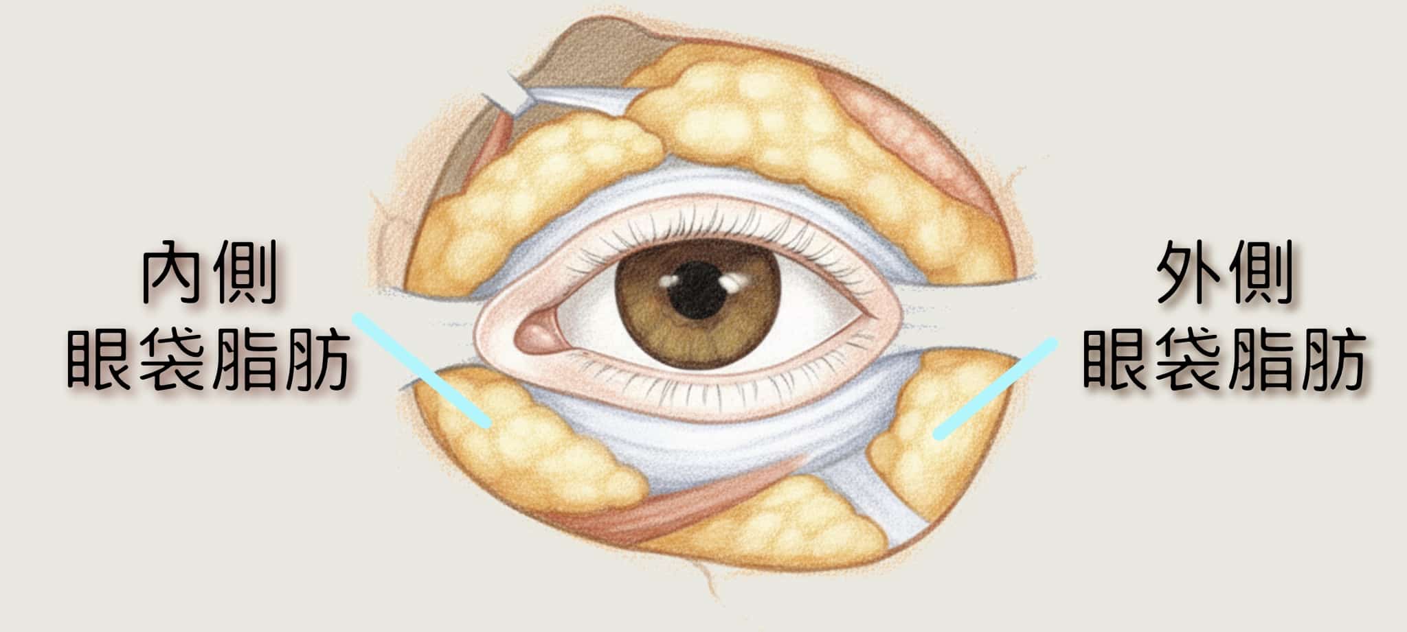 眼袋內側及外側脂肪有時會移除不足 殘餘脂肪塊