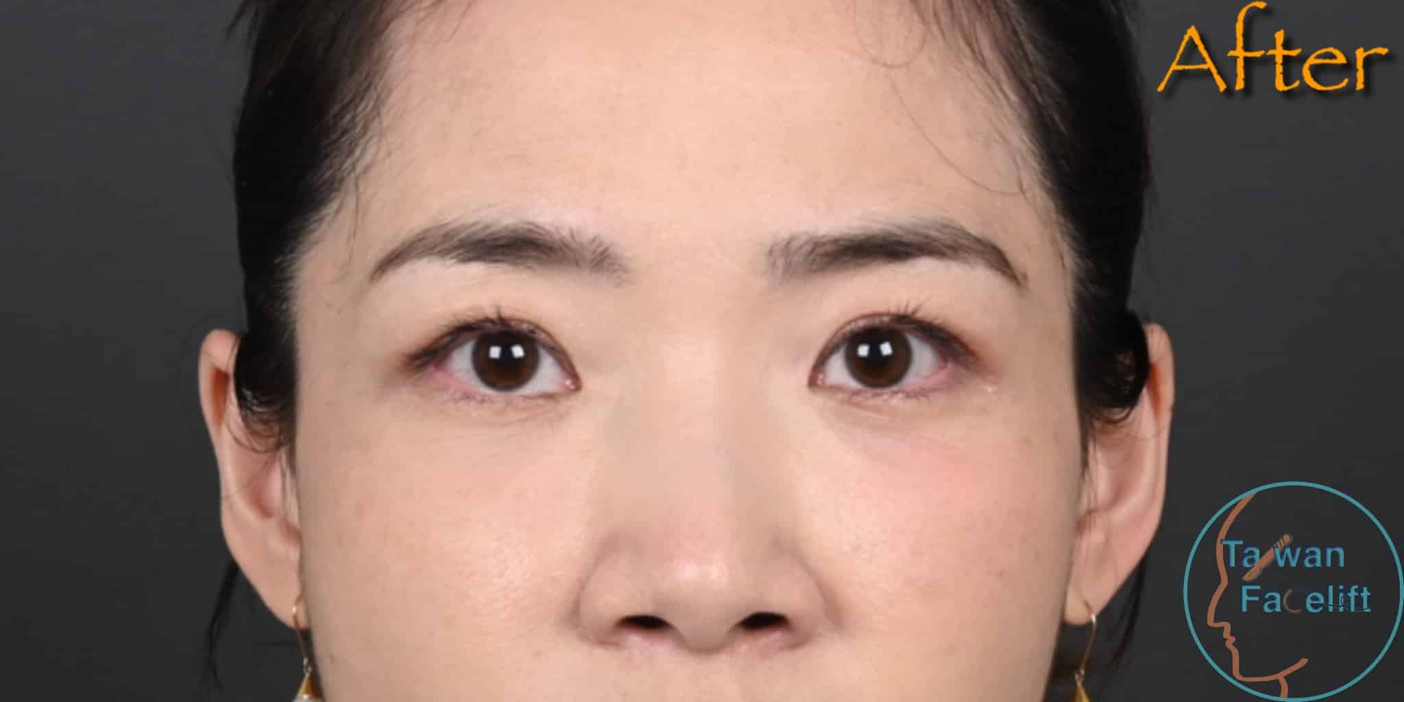 台南葉亘耕醫師進行無痕眼袋手術與補脂後，眼下平滑，重拾少女氣息。