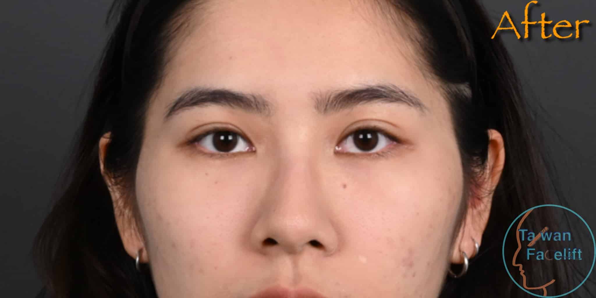 台南葉亘耕醫師進行無痕眼袋手術與補脂後，眼下恢復平滑，眼神清新自信。