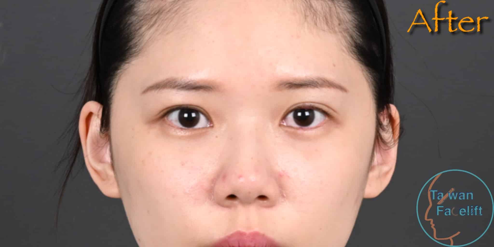 台南葉亘耕醫師進行無痕眼袋手術與精準補脂後，眼下飽滿，更顯青春光彩。