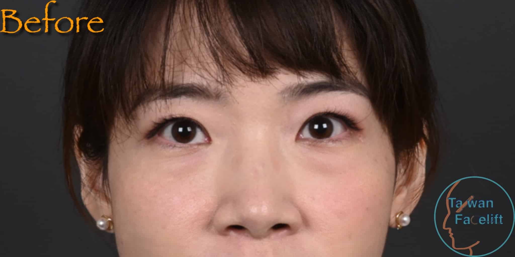 台南凡登整形外科葉亘耕醫師眼袋內開手術前，眼袋合併淚溝，看起來略顯疲憊。