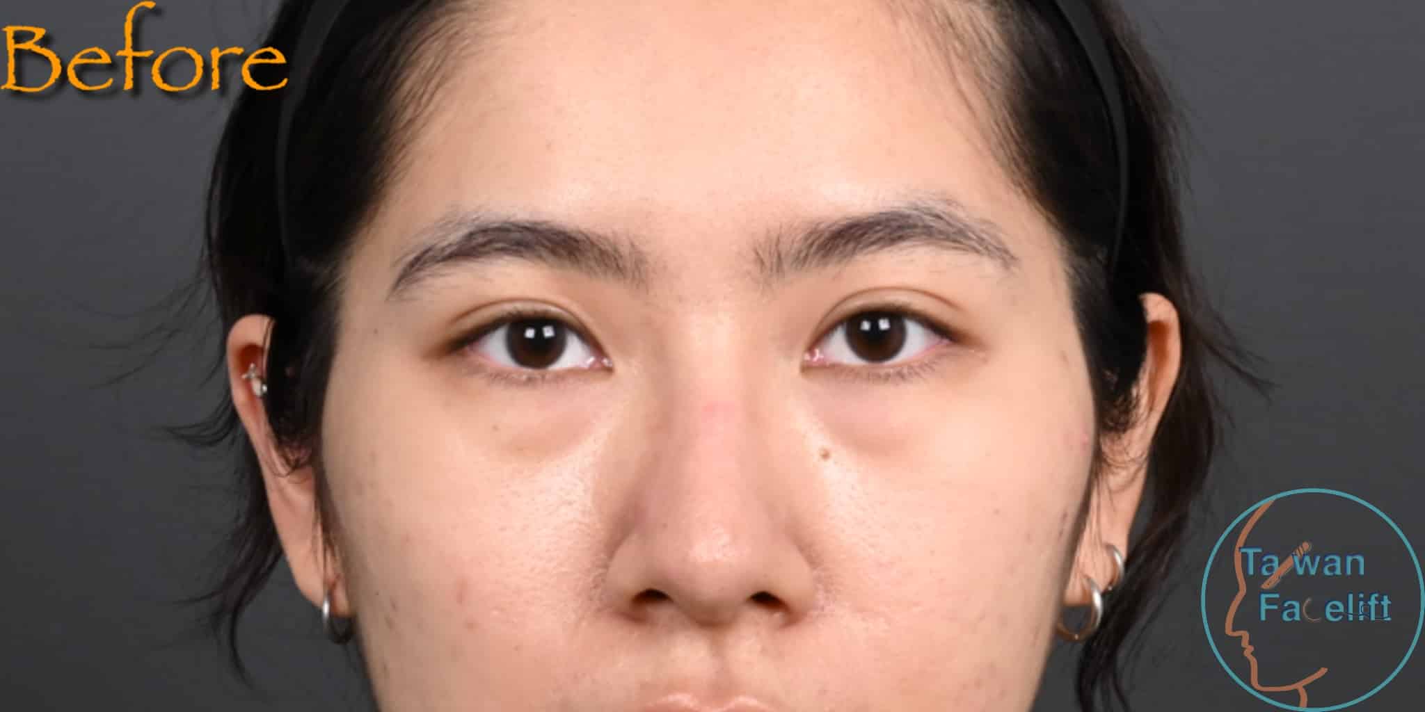 台南凡登整形外科夜亘耕醫師進行眼袋內開手術前，化妝也蓋不住的明顯眼袋讓她看起來很疲憊。