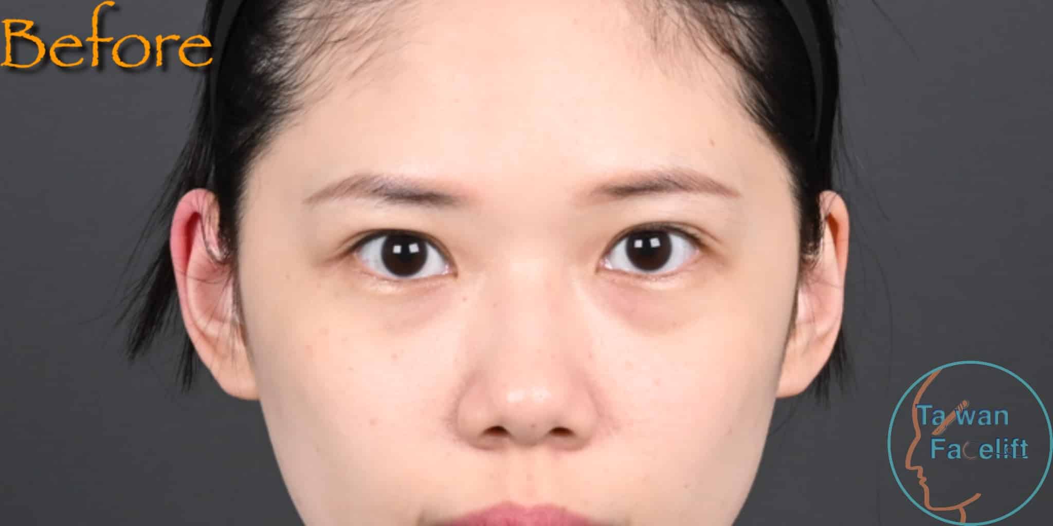 台南凡登整形外科葉亘耕醫師進行眼袋內開手術前，輕微的眼袋讓她稍顯疲憊。