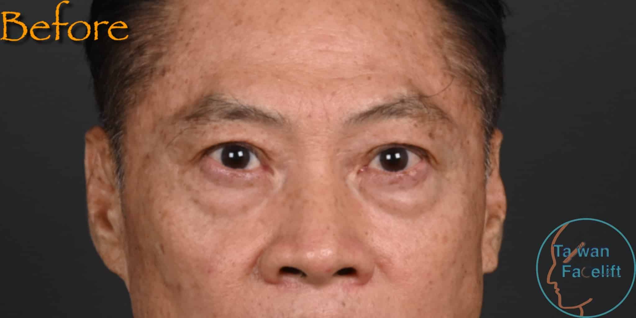 拉皮手術前，鬆弛下垂