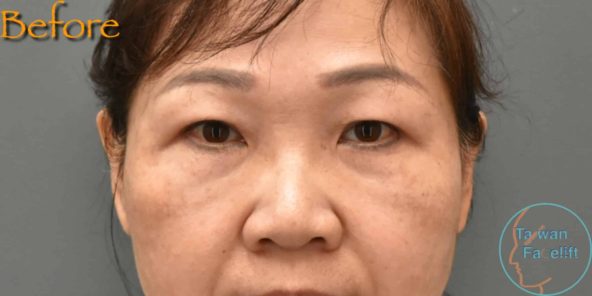 拉皮手術前，鬆弛下垂