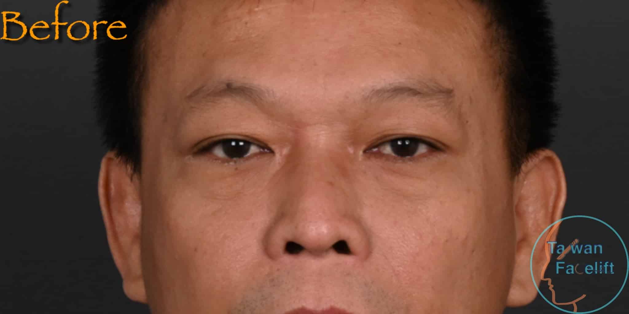 拉皮手術前，鬆弛下垂