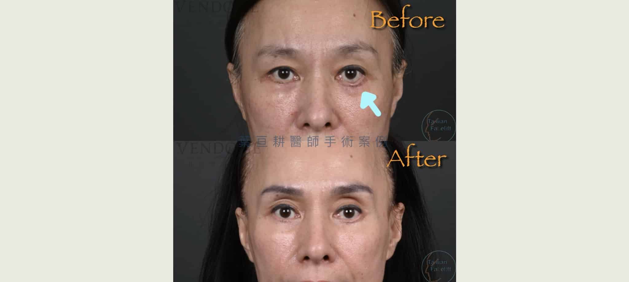 眼袋手術外翻後仍能藉由眼袋重修手術得到改善