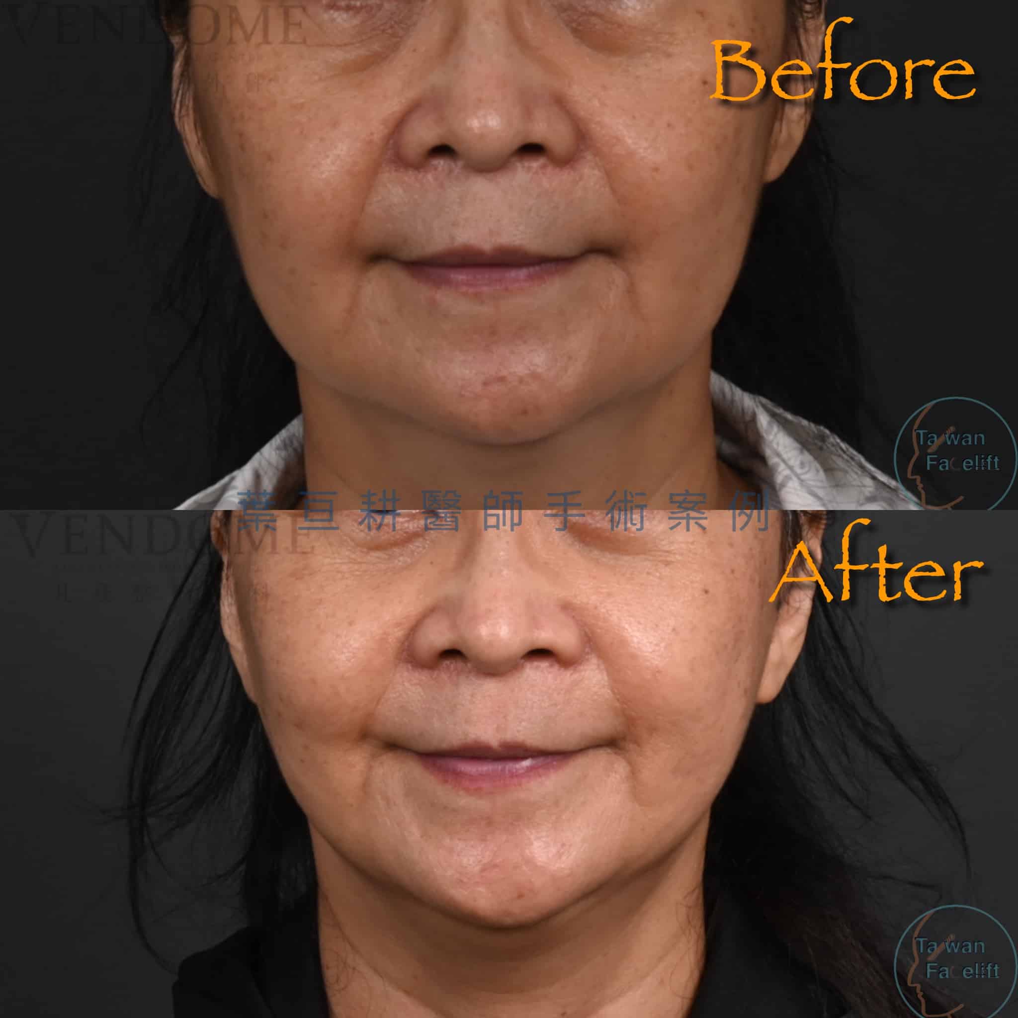 台南葉亘耕醫師中下臉拉皮手術後，吳女士下顎線緊緻，臉部年輕化。