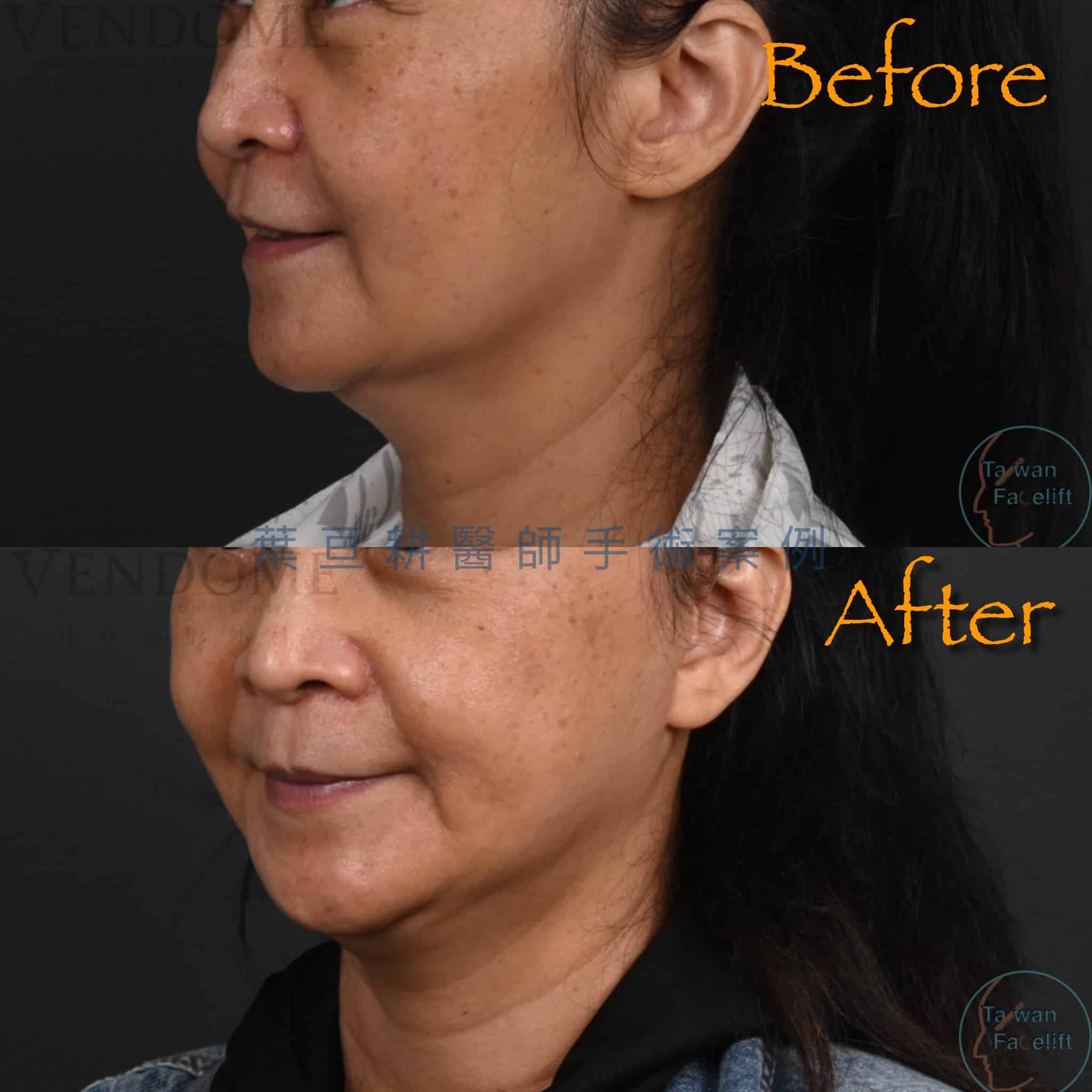 台南葉亘耕醫師中下臉拉皮手術後，吳女士下顎線緊緻，臉部年輕化。