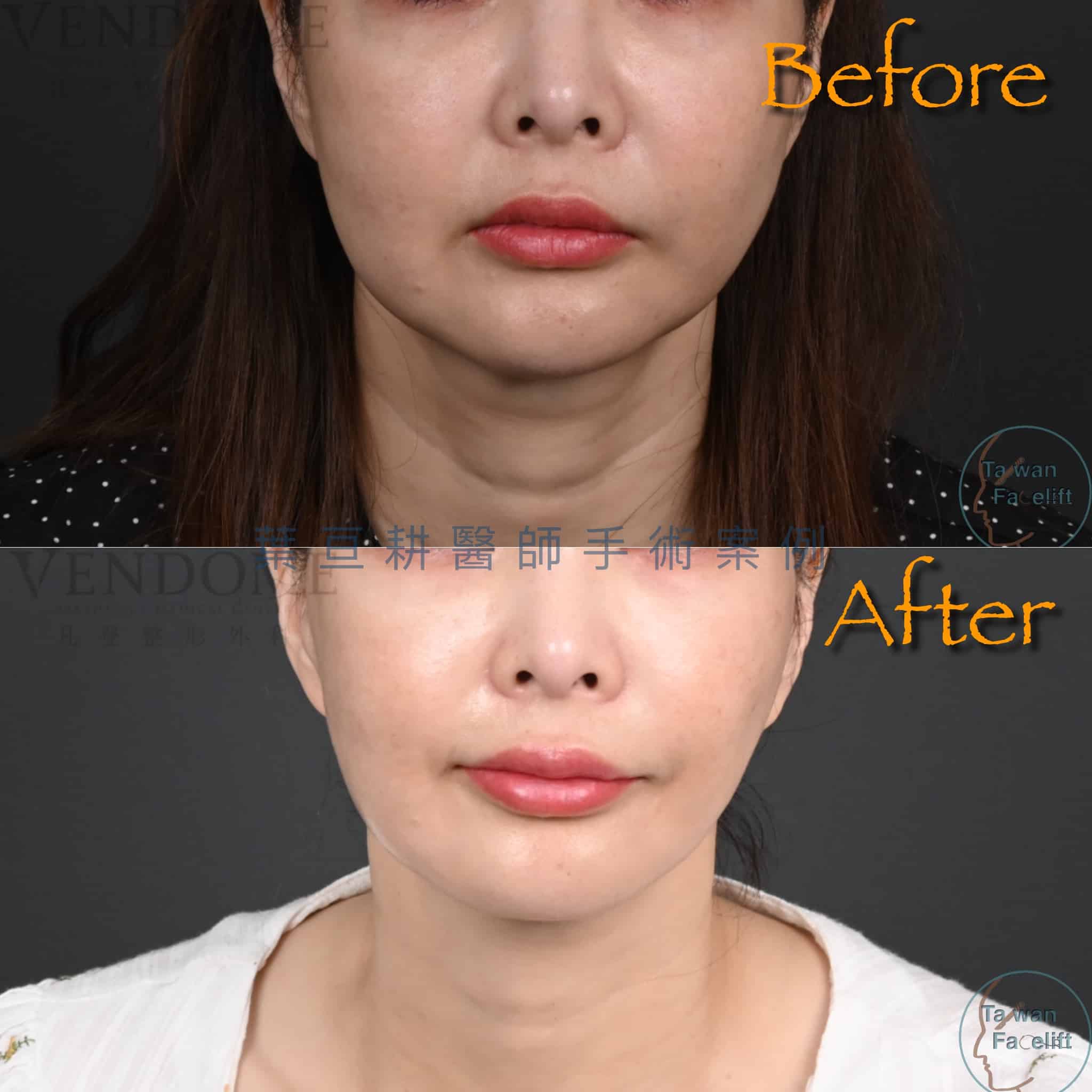 整形外科葉亘耕醫師 中下臉拉皮 天鵝頸手術改善法令紋、下頷線及頸紋案例