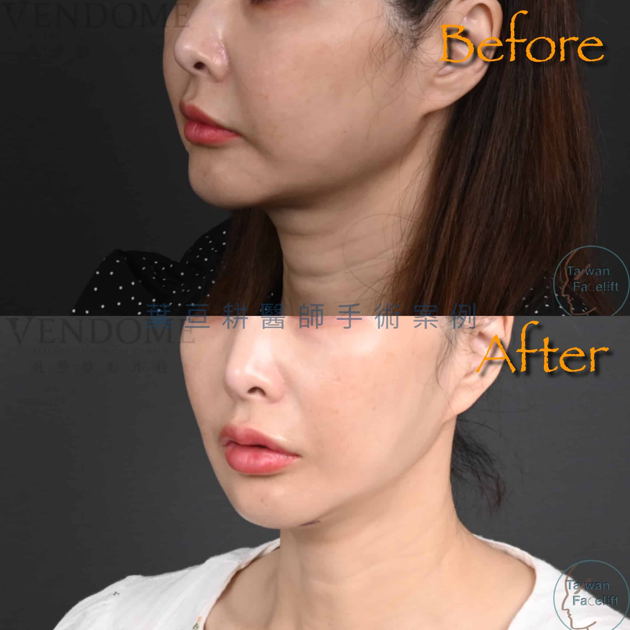 整形外科葉亘耕醫師 中下臉拉皮 天鵝頸手術改善法令紋、下頷線及頸紋案例