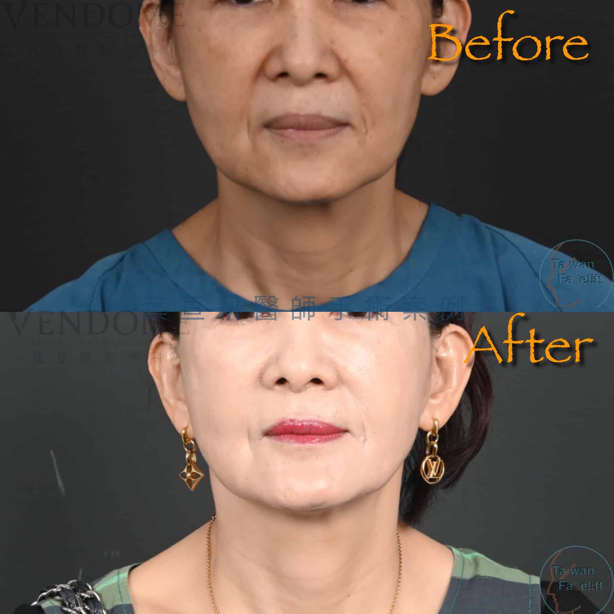 台南葉亘耕醫師中下臉拉皮手術後，劉女士臉頸部緊緻，實現自然重生。