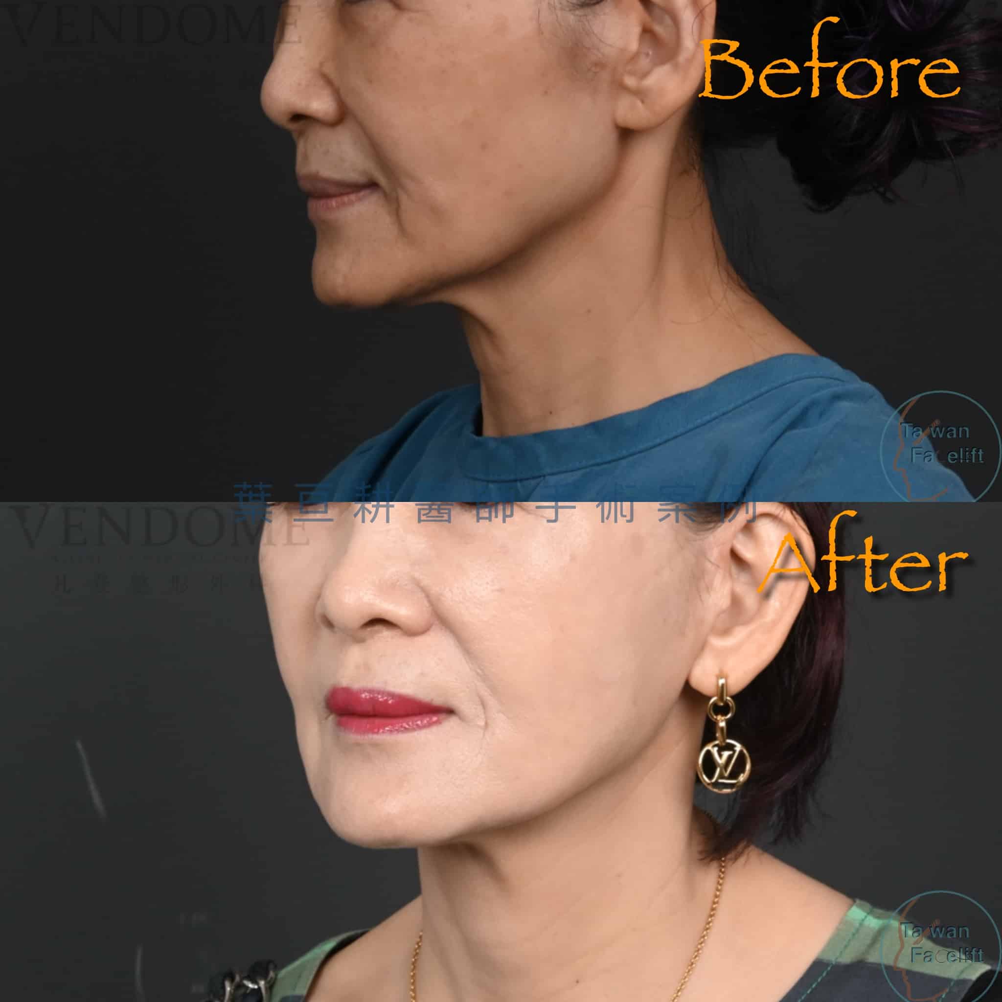 台南葉亘耕醫師中下臉拉皮手術後，劉女士臉頸部緊緻，實現自然重生。