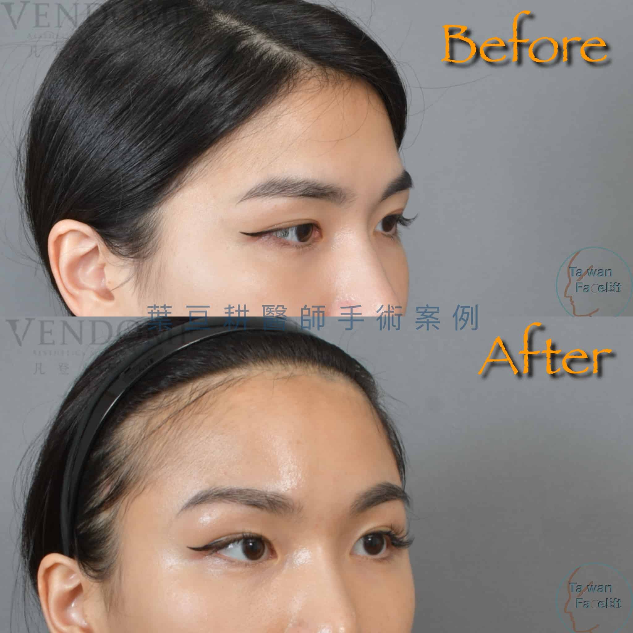 台南葉亘耕醫師內視鏡前額拉皮與偏頭痛手術後，眉眼間距改善，眼神明亮，偏頭痛減輕。