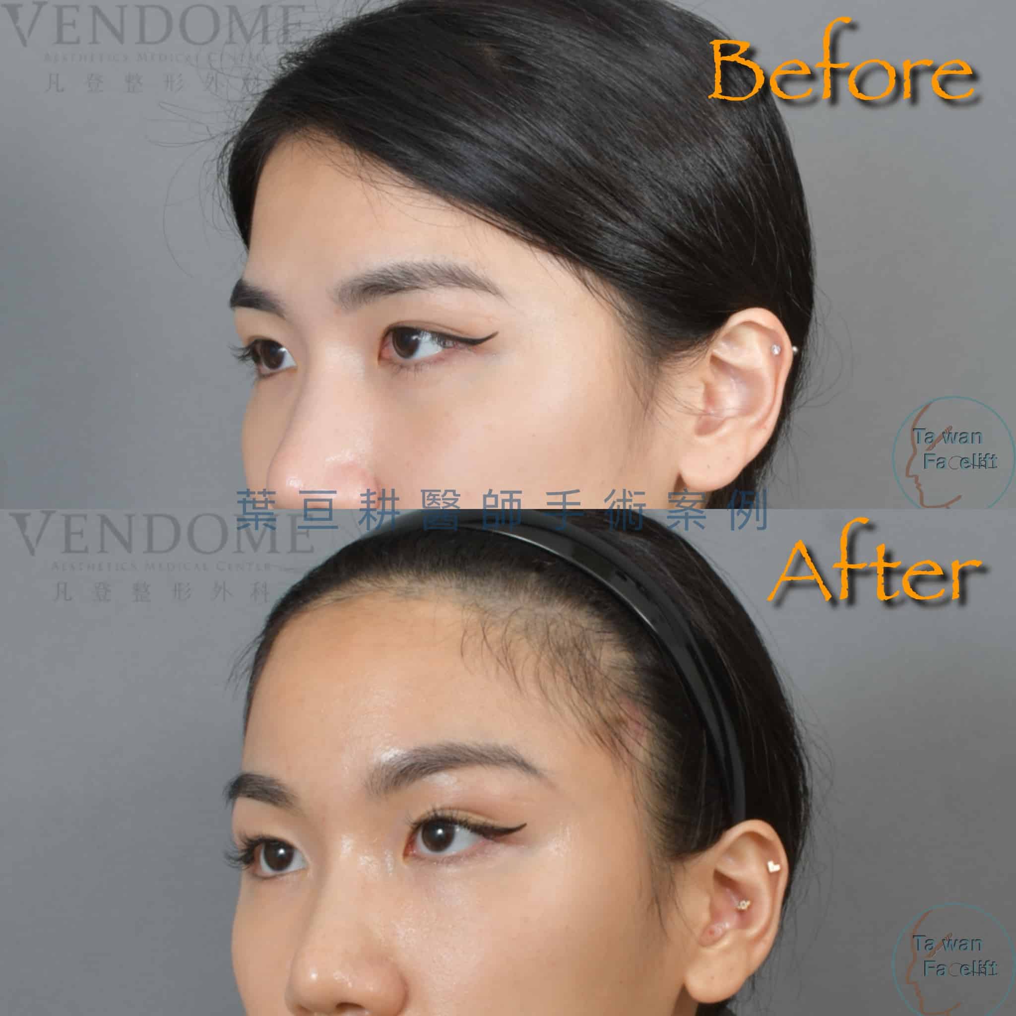 台南葉亘耕醫師內視鏡前額拉皮與偏頭痛手術後，眉眼間距改善，眼神明亮，偏頭痛減輕。