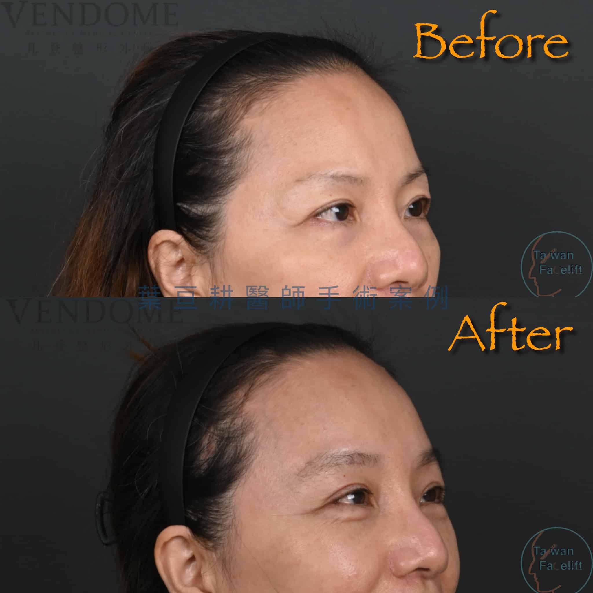 台南葉亘耕醫師內視鏡前額拉皮與眉心偏頭痛手術後，眼尾提升，眼神明亮，偏頭痛改善，疤痕隱形。