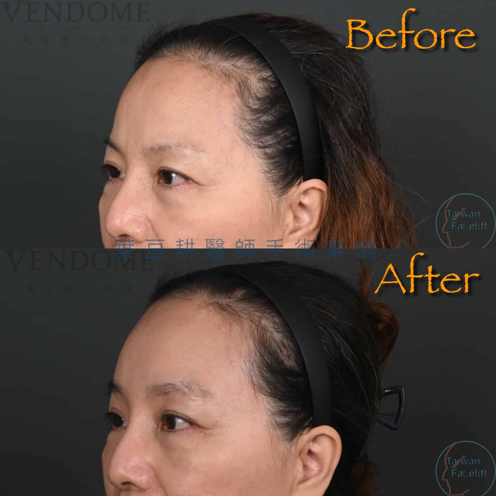 台南葉亘耕醫師內視鏡前額拉皮與眉心偏頭痛手術後，眼尾提升，眼神明亮，偏頭痛改善，疤痕隱形。