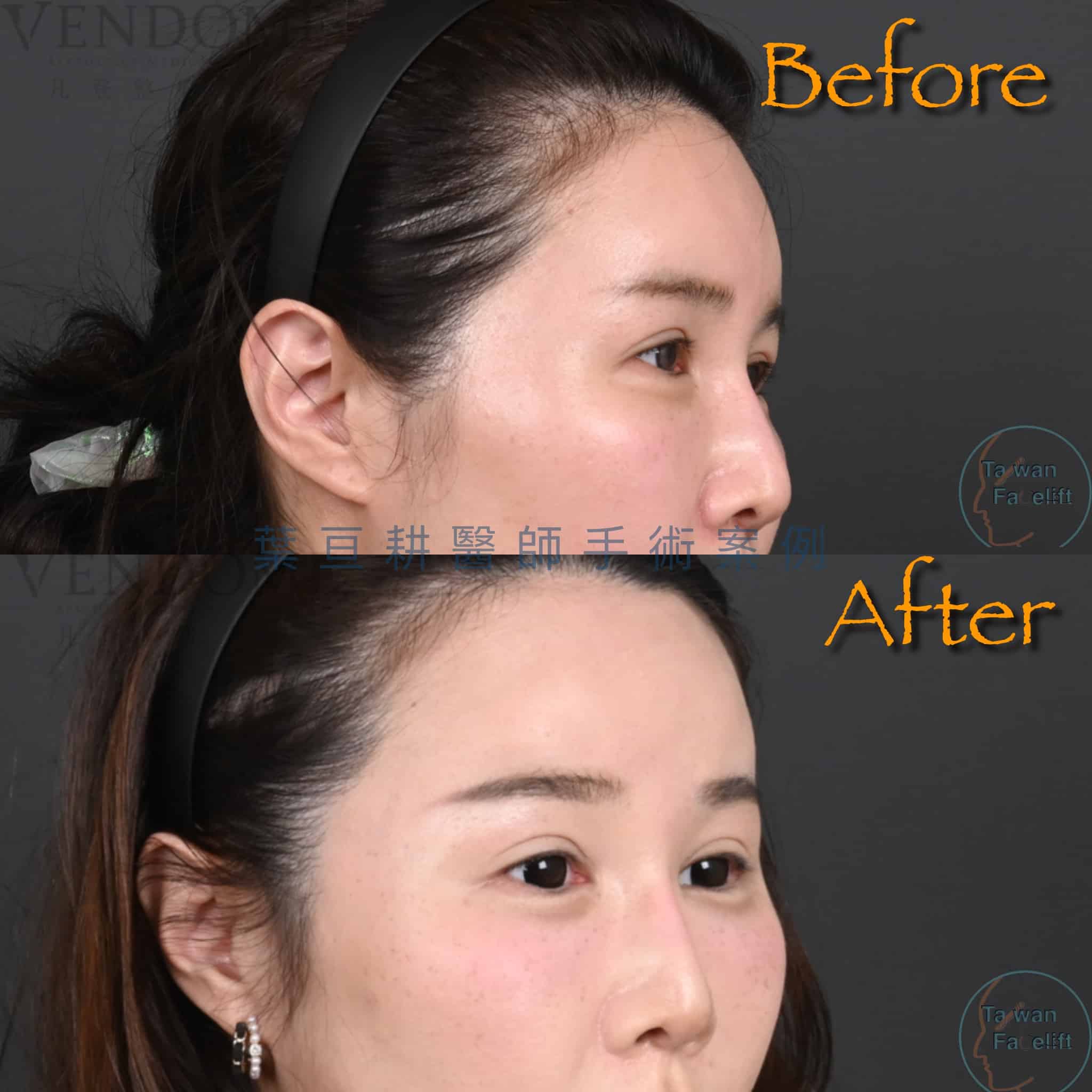 葉亘耕醫師內視鏡前額拉皮手術後，眉眼平衡，眼神年輕化。