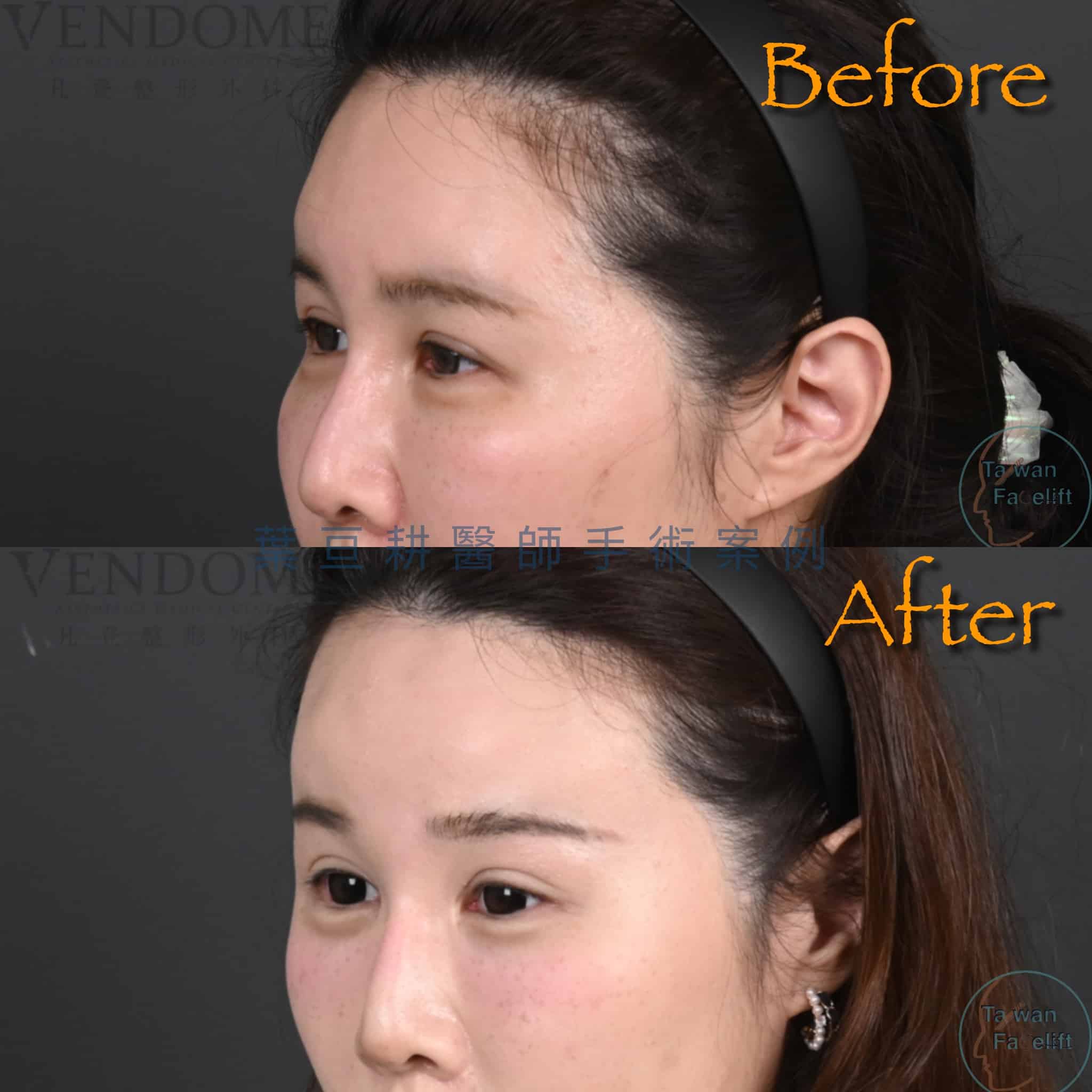 葉亘耕醫師內視鏡前額拉皮手術後，眉眼平衡，眼神年輕化。
