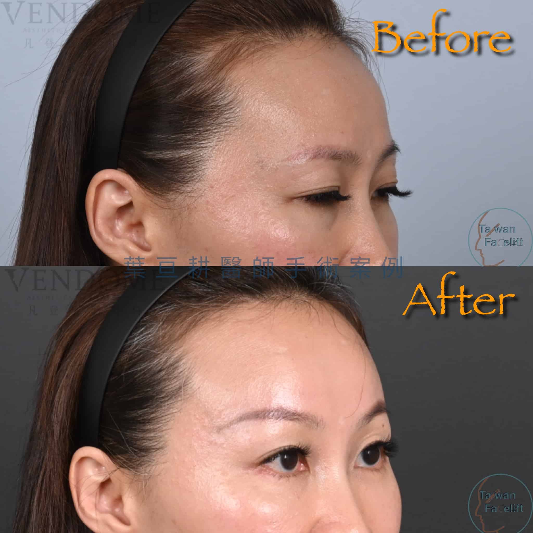 台南葉亘耕醫師內視鏡前額拉皮手術後，眉眼協調性改善，眼神更年輕。