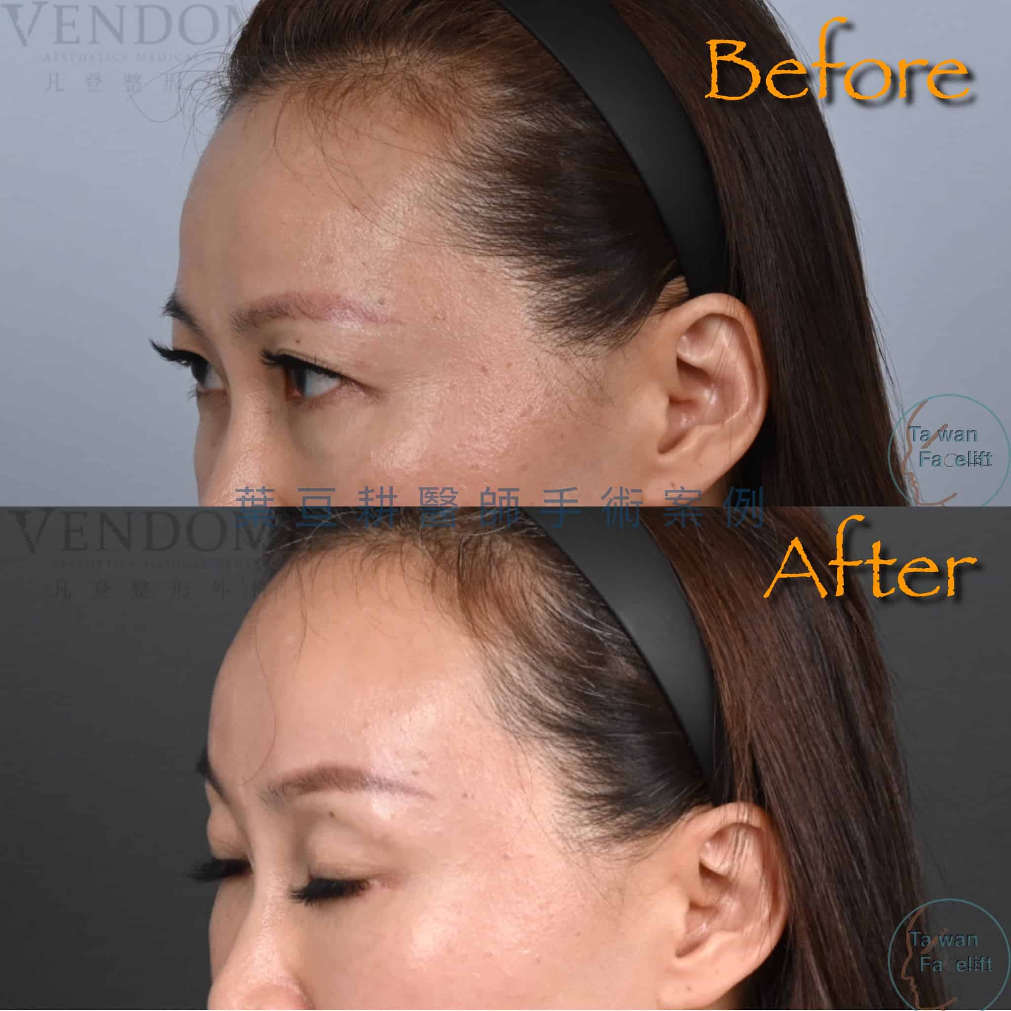 台南葉亘耕醫師內視鏡前額拉皮手術後，眉眼協調性改善，眼神更年輕。