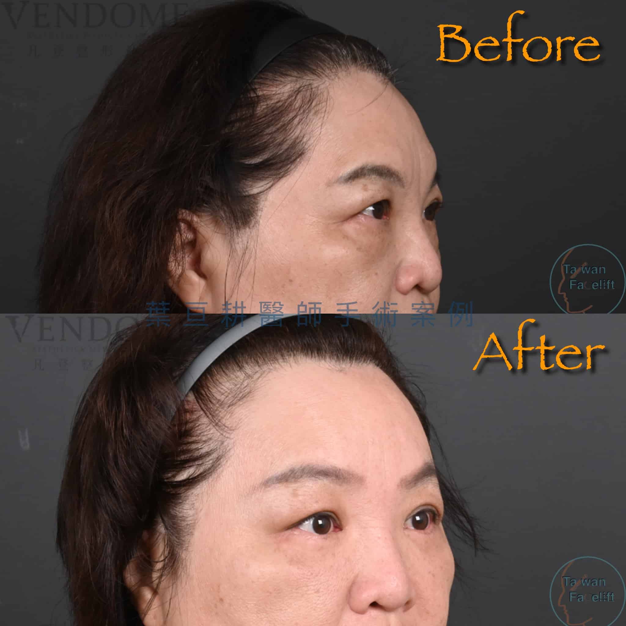 台南葉亘耕醫師內視鏡前額拉皮與前額補脂手術後，額頭平滑飽滿，皺紋改善。